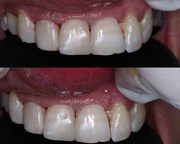 Best Dental Clinic in Mohali Veneers Doctors in Mohali,  Veneers Treatm